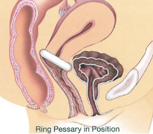 GYN&RING, prstencový pesar bez opory, velikost T1=51 mm, 1 ks