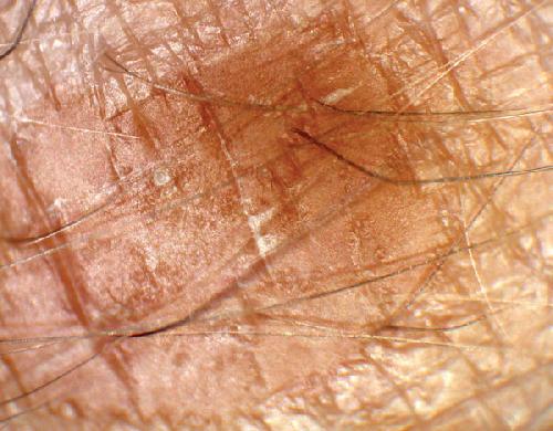 DERMLITE DL-100, moderní dermatoskop, LED diody, trvalá polarizace