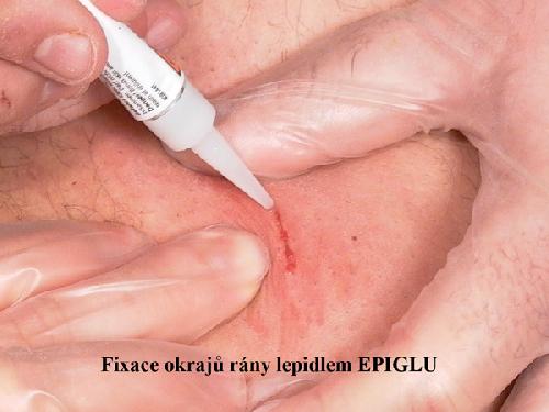 EPIGLU, tkáňové lepidlo, 4 tuby po 3 g