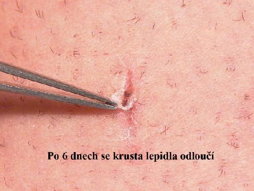 EPIGLU, tkáňové lepidlo, 4 tuby po 3 g