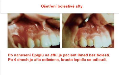 EPIGLU, tkáňové lepidlo, 4 tuby po 3 g
