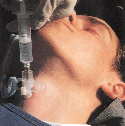 QUICK-TRACH, pro dospělé, průměr kanyly 4 mm